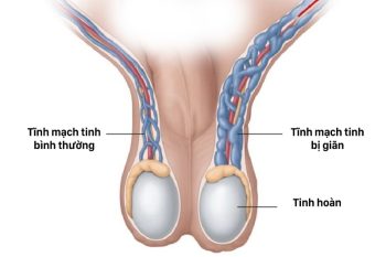 Giãn tĩnh mạch tinh có gây yếu sinh lý? Lời đáp từ Lão Tuấn