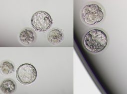 Không có tinh trùng: Nỗi lo tuyệt tự và cách bồi bổ từ gốc Thận