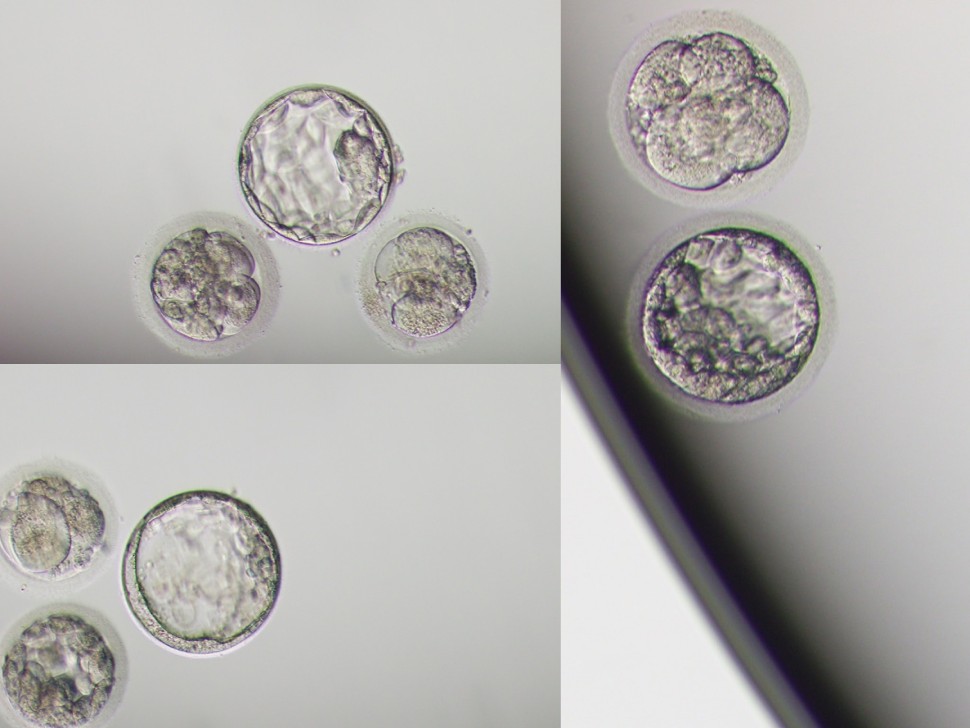 Không có tinh trùng: Nỗi lo tuyệt tự và cách bồi bổ từ gốc Thận