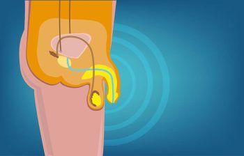 Người tiểu đường có bị yếu sinh lý không? Lời giải từ Lão Tuấn