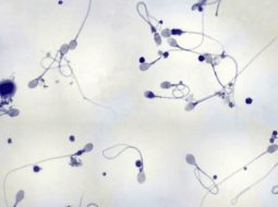 Phác đồ điều trị tinh trùng dị dạng: Bí quyết giữ gốc Thận cho Anh Em