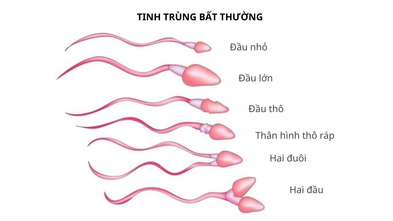 Tinh trùng đầu nhỏ là gì? Lão Tuấn mách Anh Em cách giữ "gốc" Thận
