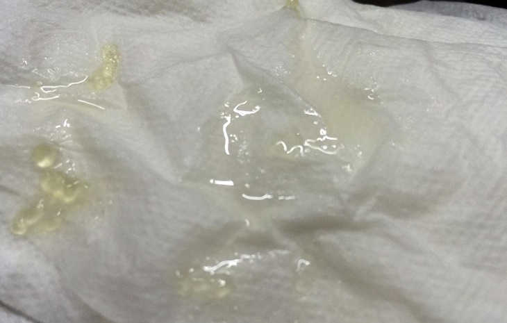 Vì sao tinh trùng bị vón cục? Lời giải từ 40 năm kinh nghiệm của Lão Tuấn