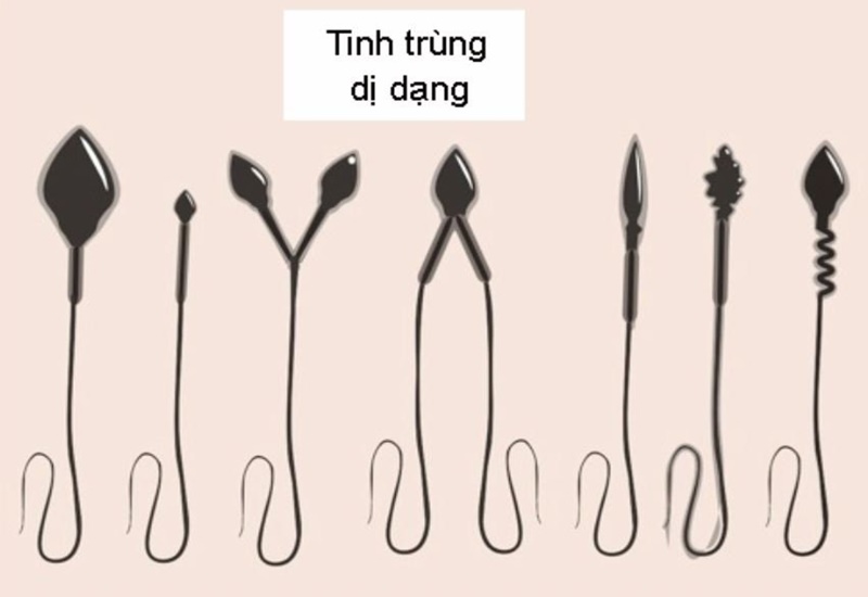 Tinh trùng dị dạng 99 có chữa được không? Lời giải từ Lão Tuấn