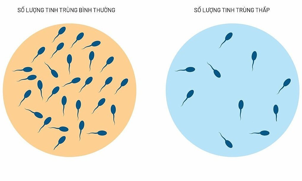 Nguyên nhân ít tinh trùng: Nỗi lo của Anh Em và cách bồi bổ từ gốc