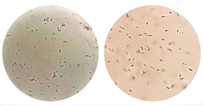 Tinh trùng bất động 40%: Anh Em đừng lo, hãy trị từ gốc Thận hư