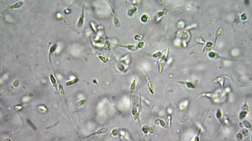 Tinh trùng khuyết tật: Nỗi lo hiếm muộn và cách hóa giải từ gốc Thận