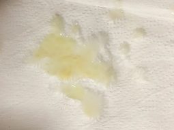 Tinh trùng màu vàng có sao không? Lời giải từ Lão Tuấn 40 năm kinh nghiệm