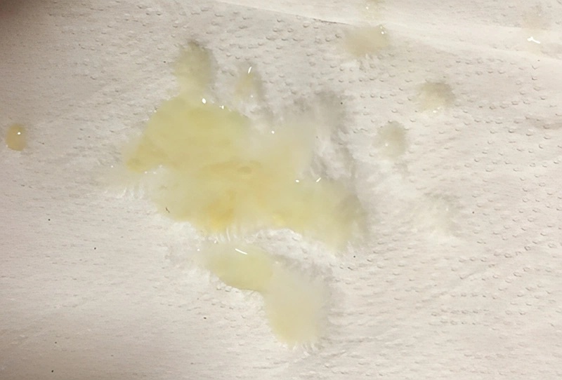 Tinh trùng màu vàng có sao không? Lời khuyên và cách cải thiện bổ tinh