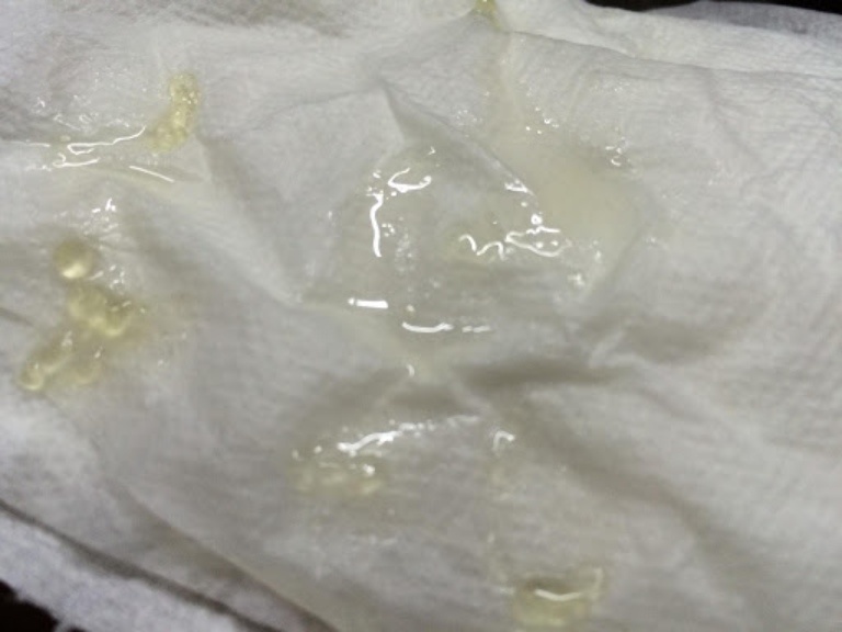 Tinh trùng màu vàng nhạt: Cảnh báo từ Thận Anh Em chớ xem thường