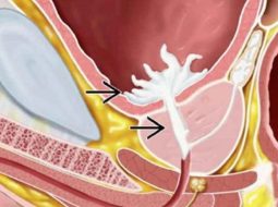 Trào ngược tinh dịch: Hiểu gốc rễ để lấy lại bản lĩnh nam giới