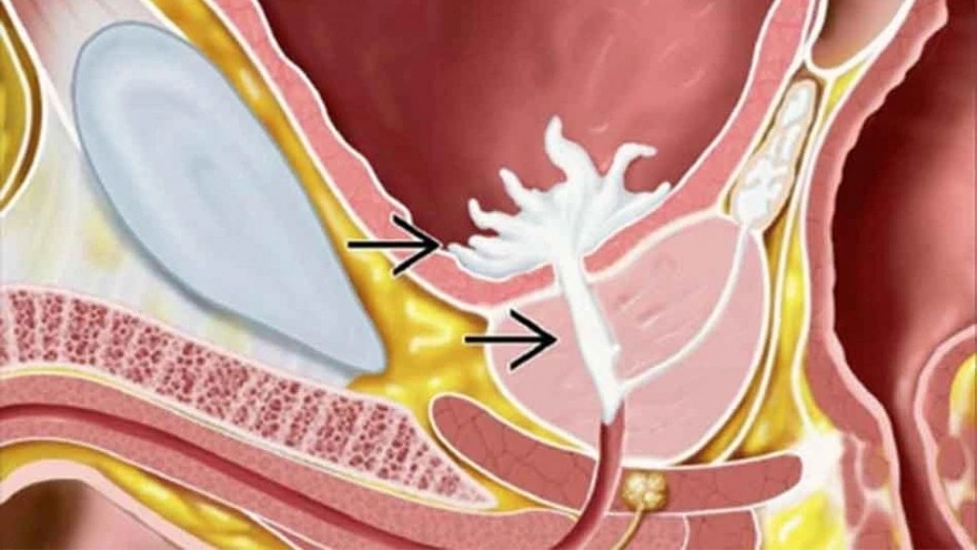 Trào ngược tinh dịch: Hiểu gốc rễ để lấy lại bản lĩnh nam giới