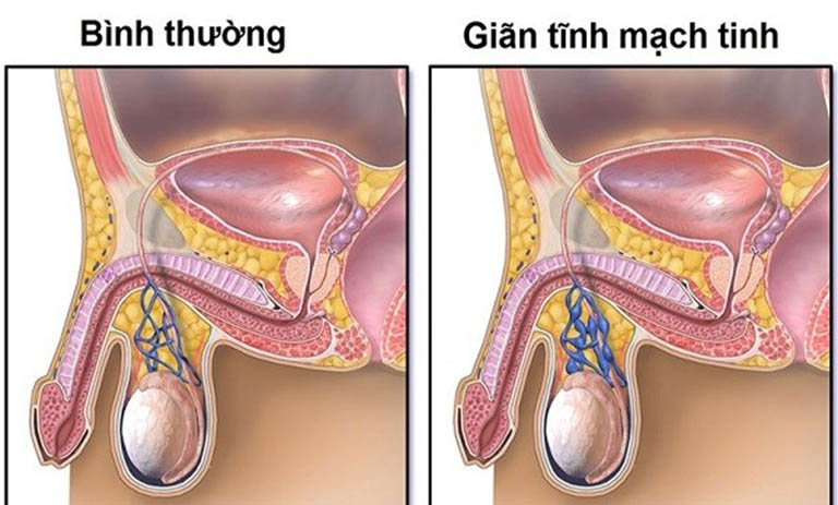 Giãn tĩnh mạch thừng tinh gây rối loạn cương dương: Cách khắc phục giúp Anh Em bền bỉ