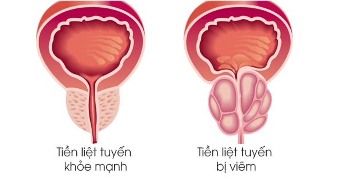 Viêm tuyến tiền liệt có gây rối loạn cương dương? Lời giải từ Lão Tuấn