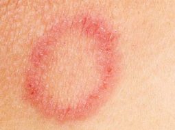 Da nổi mẩn đỏ ngứa hình tròn: Cẩn thận kẻo "nuôi" bệnh trong người