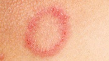 Da nổi mẩn đỏ ngứa hình tròn: Cẩn thận kẻo "nuôi" bệnh trong người