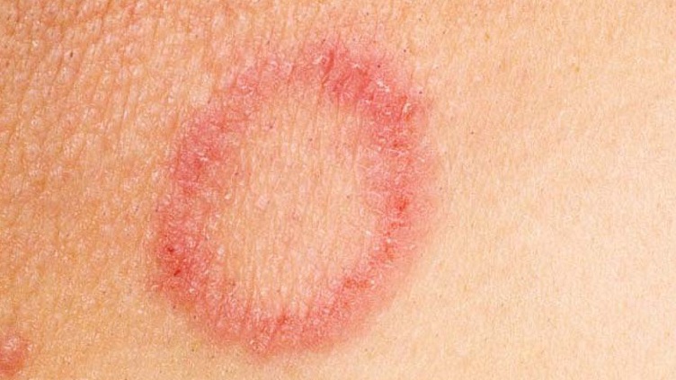 Da nổi mẩn đỏ ngứa hình tròn: Cẩn thận kẻo "nuôi" bệnh trong người