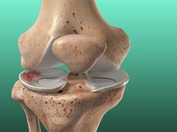 Khô khớp gối – Đừng để tiếng kêu lạo xạo cản bước chân tuổi già