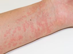 Nổi mề đay làm gì cho hết ngứa? Mẹo hay dịu ngay cơn ngứa