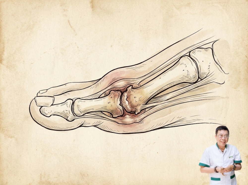 viêm khớp ngón chân cái. từ khóa này thuộc nhóm triệu chứng bệnh lý. nội dung triển khai cần bám sát viêm khớp ngón chân cái. từ khóa này thuộc nhóm triệu chứng bệnh lý. nội dung triển khai cần bám sát