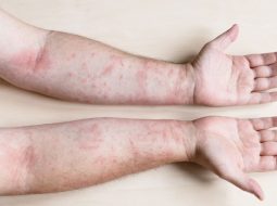 Dị ứng mẩn ngứa: Trị từ gốc tạng phủ để dứt cơn ngứa dai dẳng