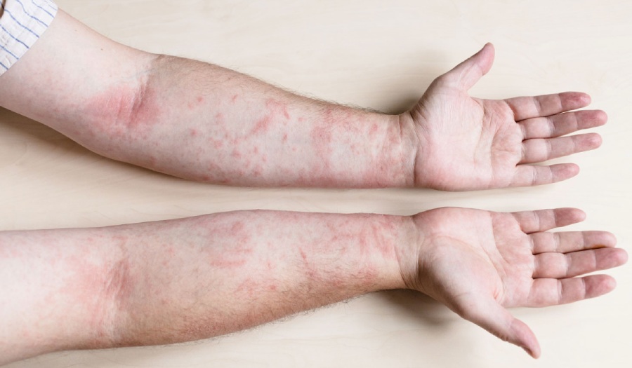 Dị ứng mẩn ngứa: Trị từ gốc tạng phủ để dứt cơn ngứa dai dẳng