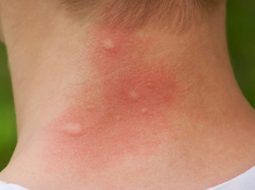Nổi mẩn đỏ ngứa như muỗi đốt: Coi chừng phong độc chạy trong huyết