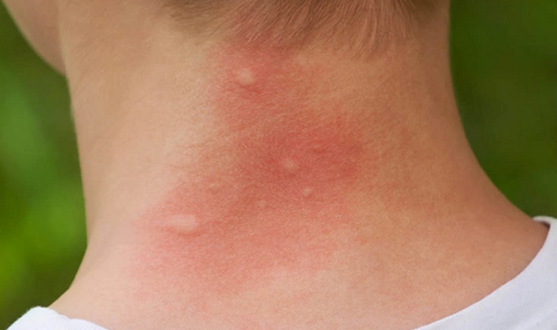 Nổi mẩn đỏ ngứa như muỗi đốt: Coi chừng phong độc chạy trong huyết