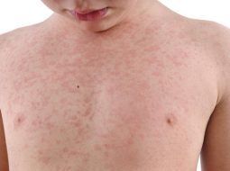 Trẻ bị nóng trong mẩn ngứa: Lão Tuấn bày cách trị từ gốc cho con