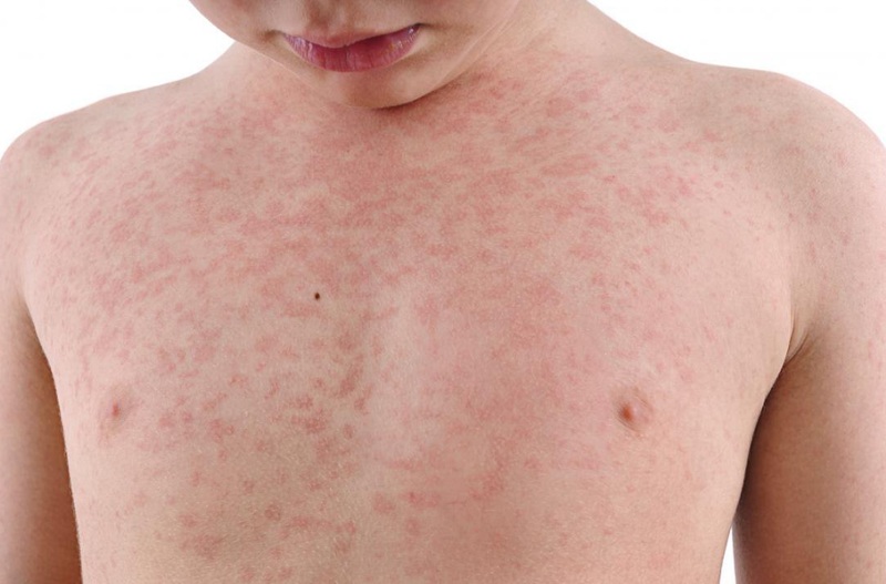 Trẻ bị nóng trong mẩn ngứa: Lão Tuấn bày cách trị từ gốc cho con