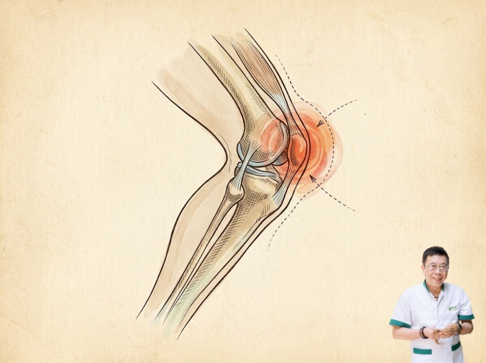 Đau khớp gối sau khi chạy bộ