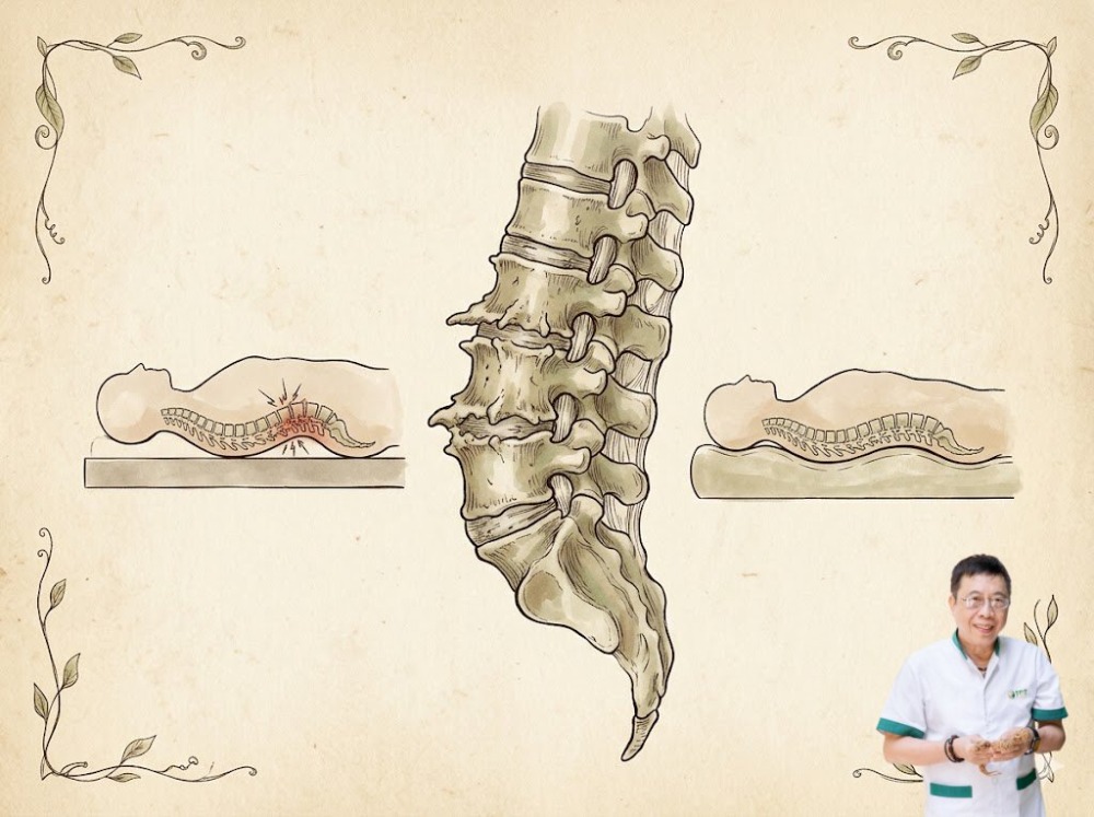 Gai cột sống có nên nằm nệm cứng