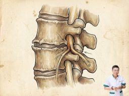 Thoái hóa cột sống có ảnh hưởng chèn dây thần kinh không?