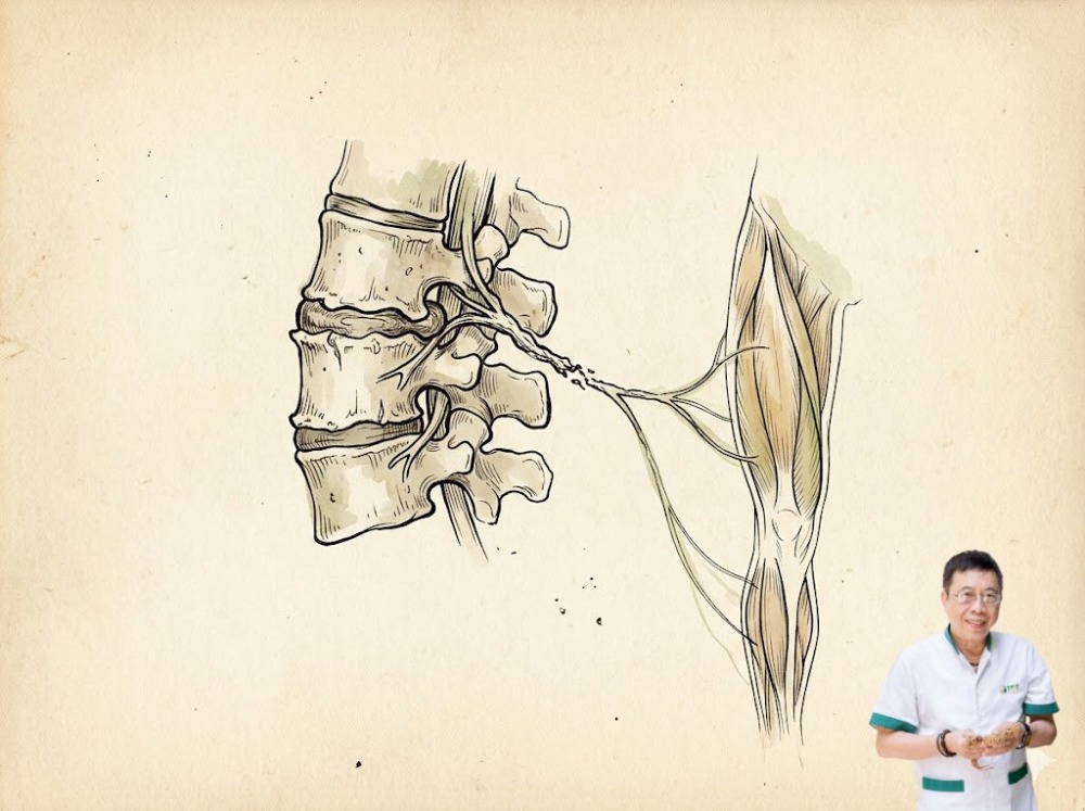 Thoái hóa cột sống có gây yếu cơ không