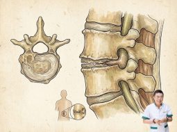 Thoái hóa cột sống do làm việc nặng nguy hiểm thế nào?
