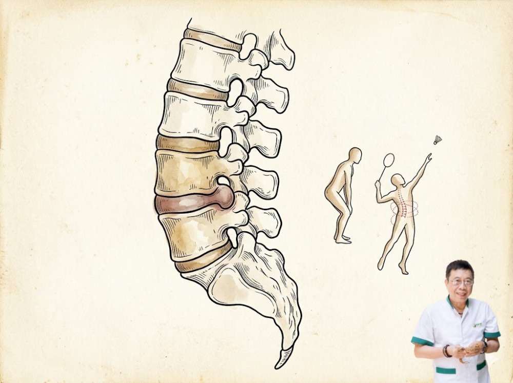 Thoát vị đĩa đệm có nên chơi cầu lông