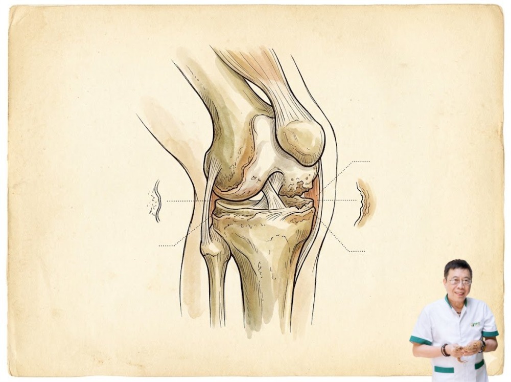 Viêm khớp gối ở người trẻ Viêm khớp gối ở người trẻ