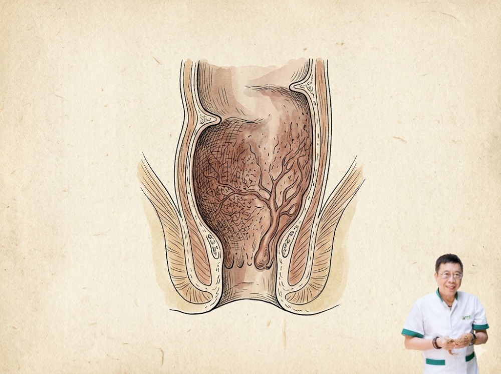Viêm xung huyết trực tràng